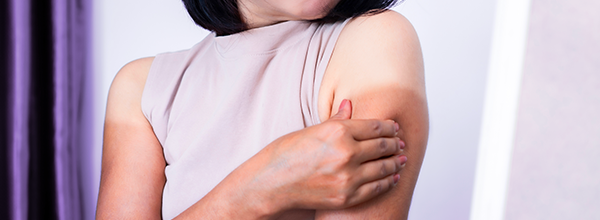 10 Cara Mengembalikan Kulit yang Gosong Abis Liburan